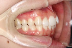 右の第二小臼歯は逆被蓋になっています